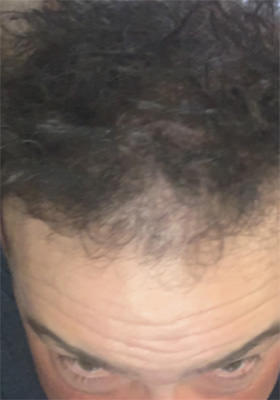 hair transplant before after Photos