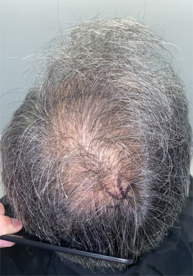 hair transplant before after Photos