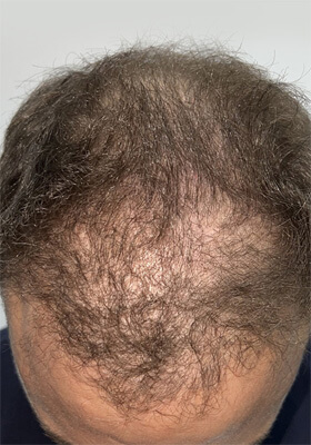 hair transplant photos