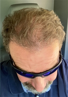 hair transplant before after Photos