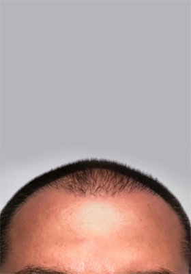 hair transplant photos