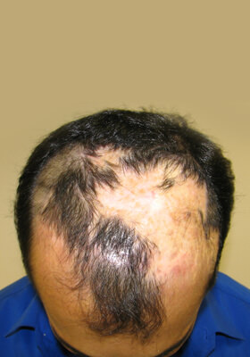 hair transplant before after Photos