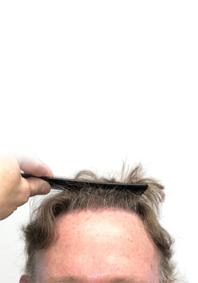 hair transplant photos