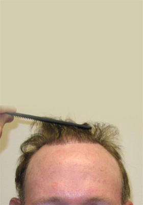 hair transplant photos