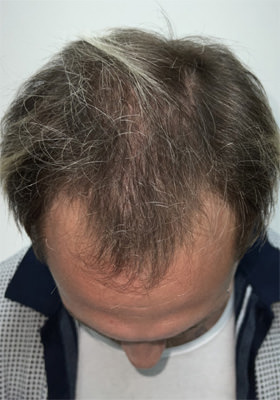 hair transplant before after Photos