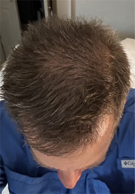 hair transplant photos