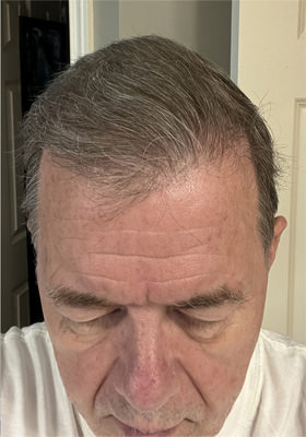 hair transplant before after Photos