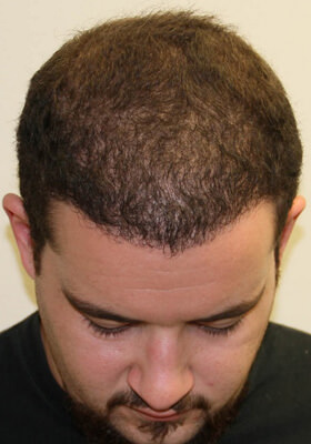 hair transplant photos