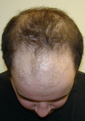 hair transplant before after Photos