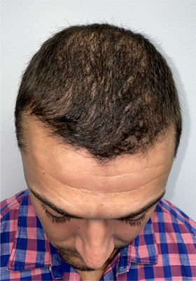 hair transplant photos