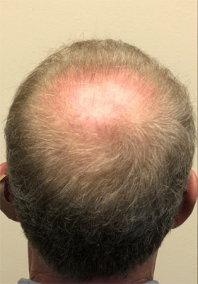 hair transplant before after Photos