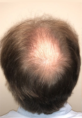 hair transplant before after Photos