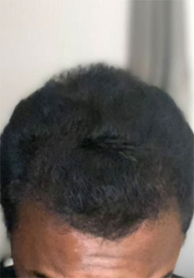 hair transplant before after Photos