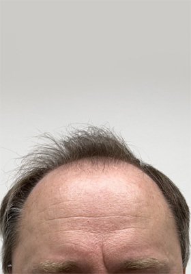 hair transplant before after Photos