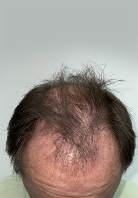 hair transplant before after Photos