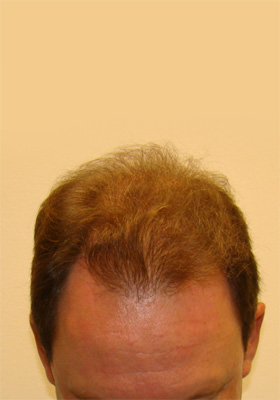 hair transplant before after Photos