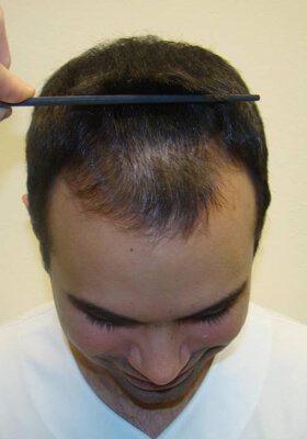 hair transplant before after Photos