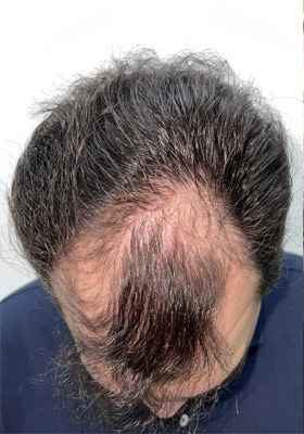 hair transplant before after Photos