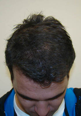 hair transplant photos