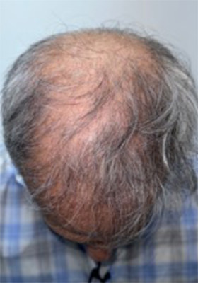 hair transplant photos