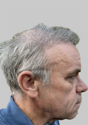 hair transplant before after Photos