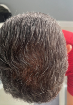 hair transplant before after Photos