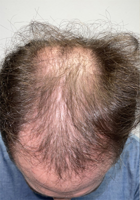 hair transplant photos