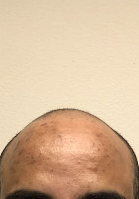 hair transplant before after Photos