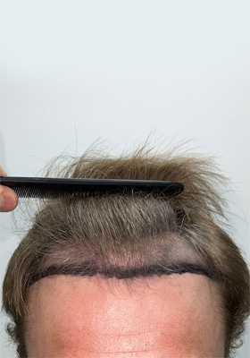 hair transplant before after Photos