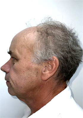 hair transplant photos