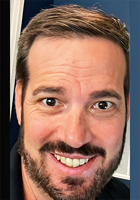 hair transplant before after Photos