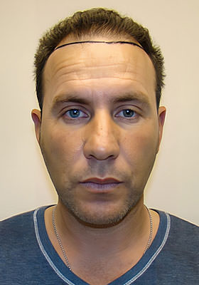 hair transplant before after Photos