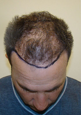 hair transplant before after Photos