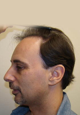 hair transplant before after Photos