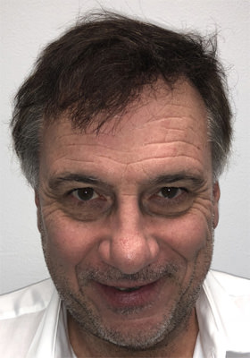 hair transplant photos