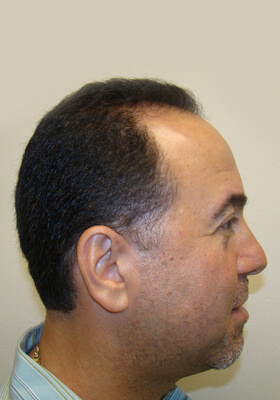 hair transplant before after Photos