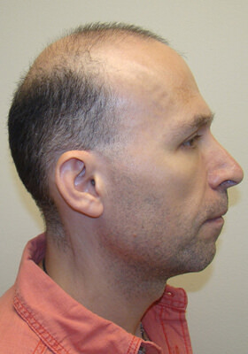 hair transplant before after Photos