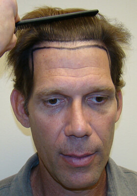 hair transplant photos