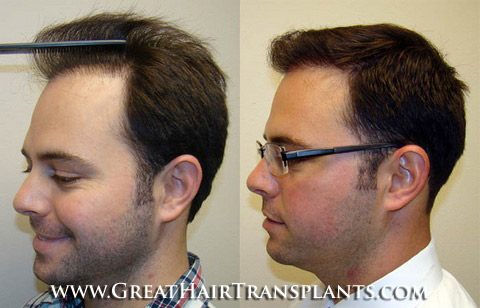 how much does a hair transplant cost