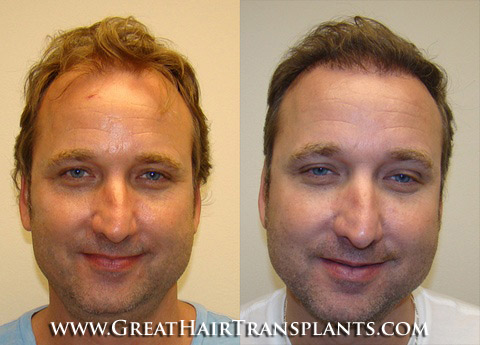 surgical hair restoration