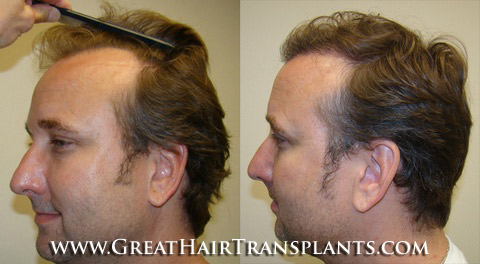 hair implant