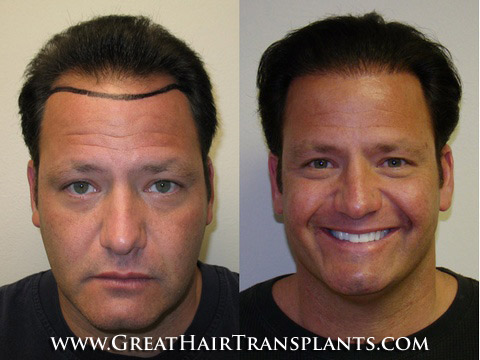 hair restoration