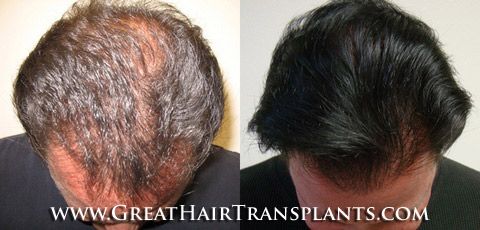 hair transplants