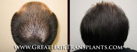 hair loss treatments