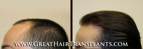 hair restoration