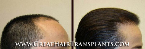 how much does a hair transplant cost