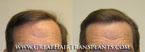 surgical hair restoration