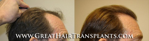 low cost hair transplant