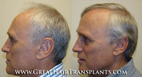 how much does a hair transplant cost