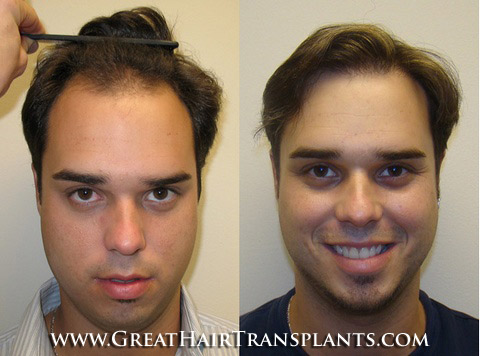 hair restoration